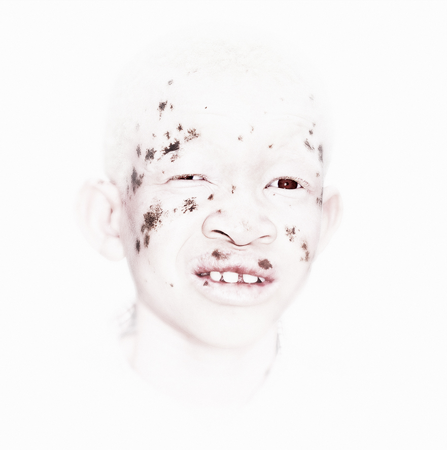 Albino Boy 2